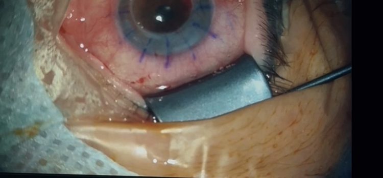 Алматы қаласы Орталық қалалық клиникалық аурухана офтольмологтары екі науқасқа қасаң қабақ ауыстыру арқылы көру қабілетін қайтарды Алматы қаласы Орталық қалалық клиникалық аурухана офтольмологтары екі науқасқа қасаң қабақ ауыстыру арқылы көру қабілетін қайтарды